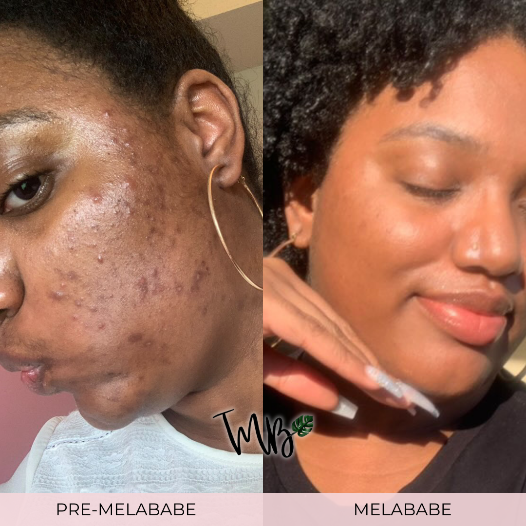 Why Do I Keep Getting Dark Spots?