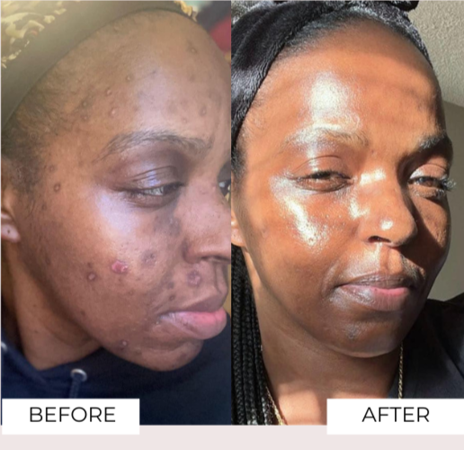 healing dark spots and open sores on black skin