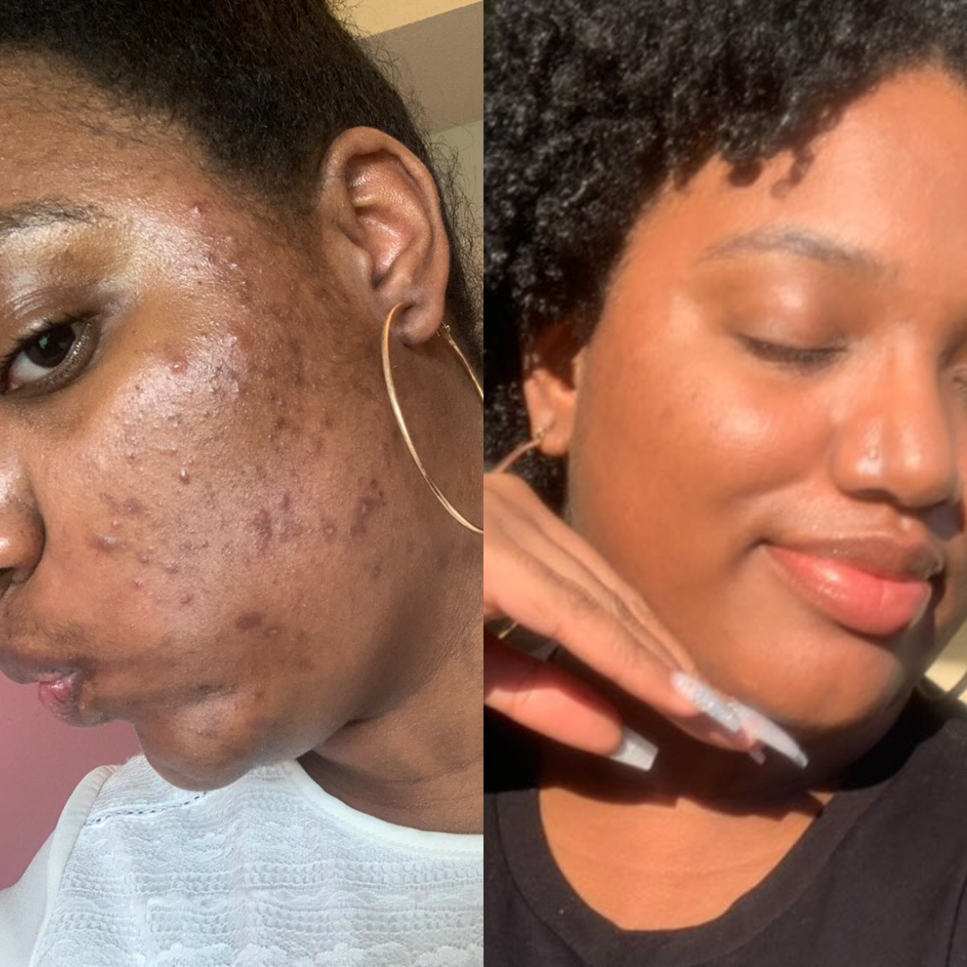 Why Does My Skincare Burn? Top Causes & How to Fix It Fast!